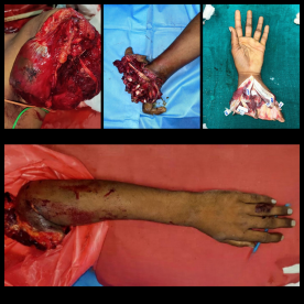 Landmark Cross-Hand Replantation at RGGG